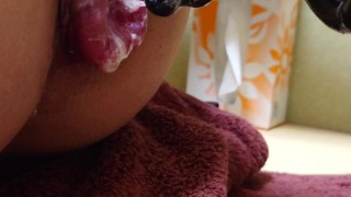 アナル吸引 アナルローズ拡張2